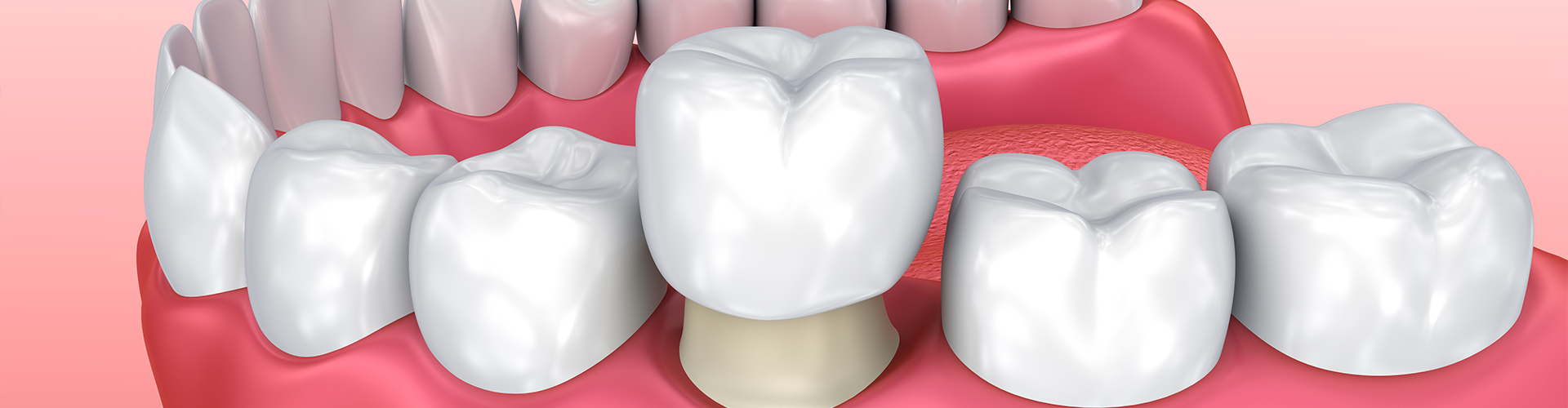 A Comprehensive Guide to Dental Crowns