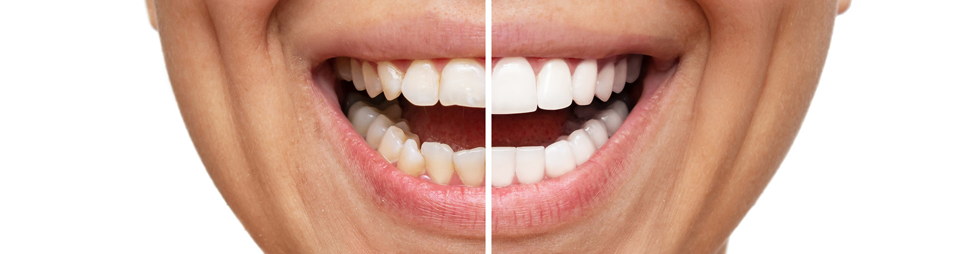 Veneers: The Perfect Solution for a Brilliant Smile