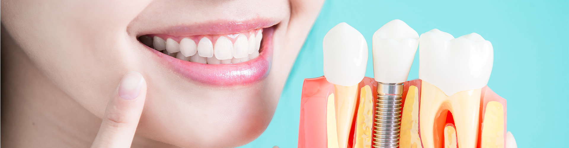 How Dental Implants Can Improve Your Quality of Life