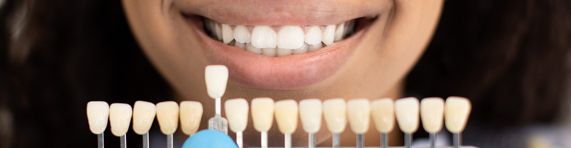 Lumineers vs Veneers: Which is the Right Choice for You?