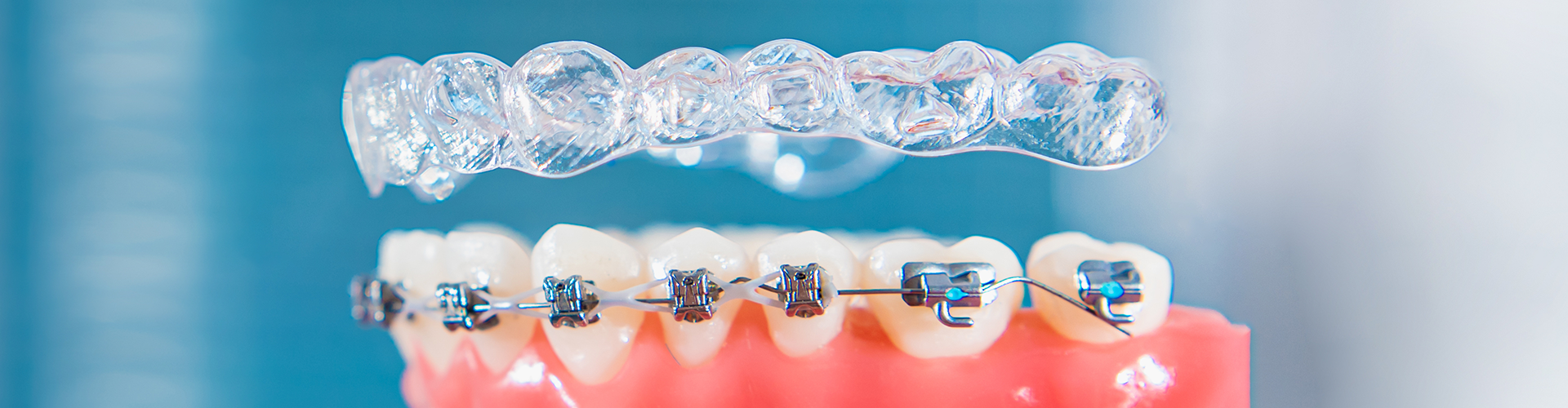 Aligners vs Braces: Unraveling the Best Choice for Your Dental Journey