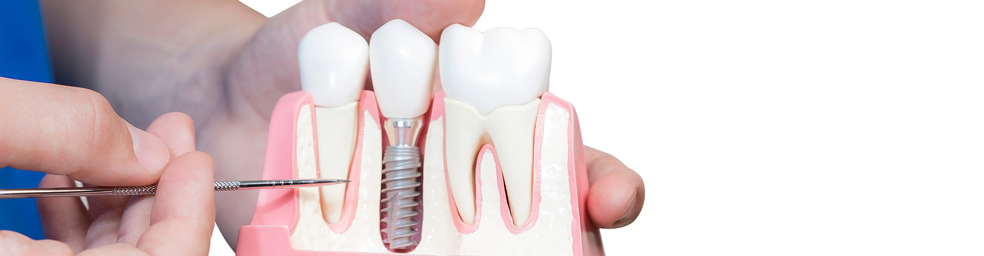Revolutionizing Smiles with Dental Implant Technology