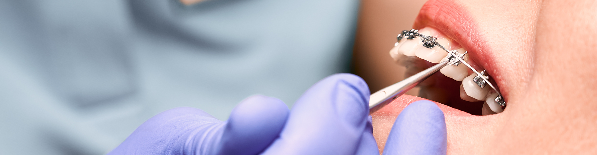 Why Metal Braces Are the Reliable Choice for Straight Teeth