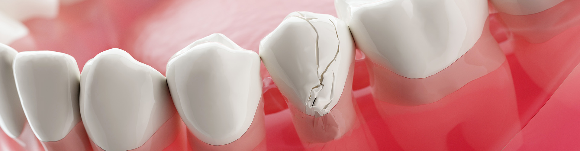 Navigating the Maze of a Cracked or Chipped Tooth: When to Sound the Alarm