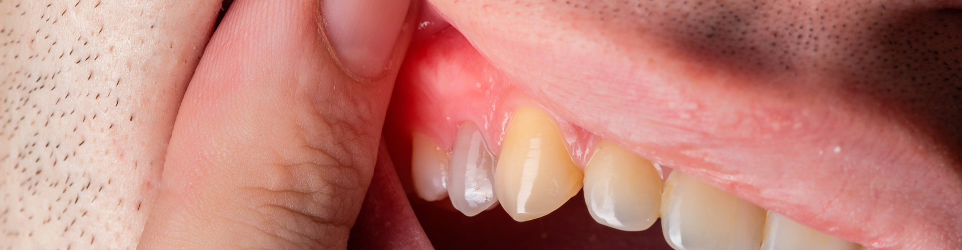Ouch! That Toothache Could Be a Root Canal in Disguise
