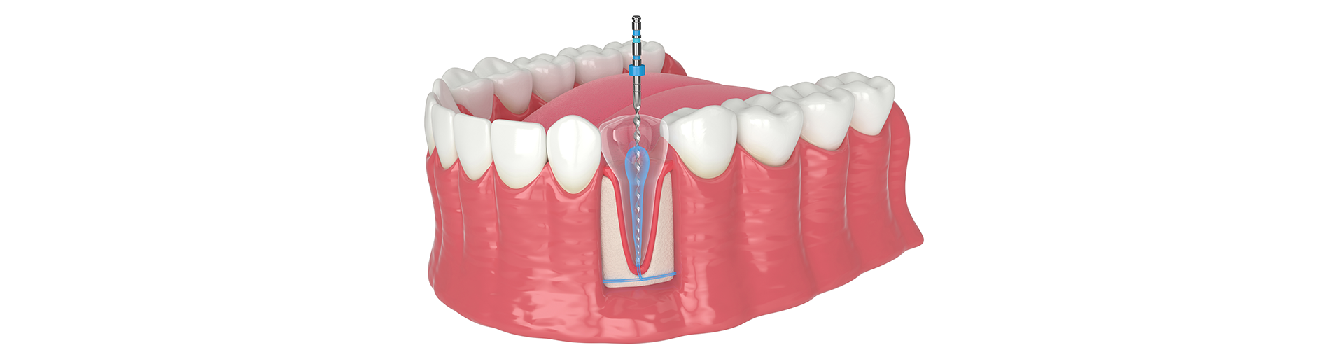 Why Seeing an Endodontist Can Save Your Smile