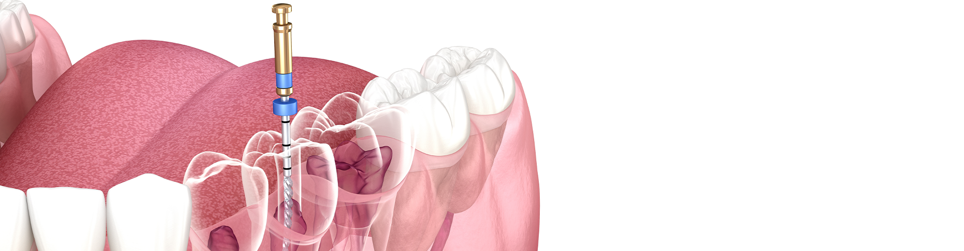 Post Root Canal Care – Essential Tips for a Smooth Recovery