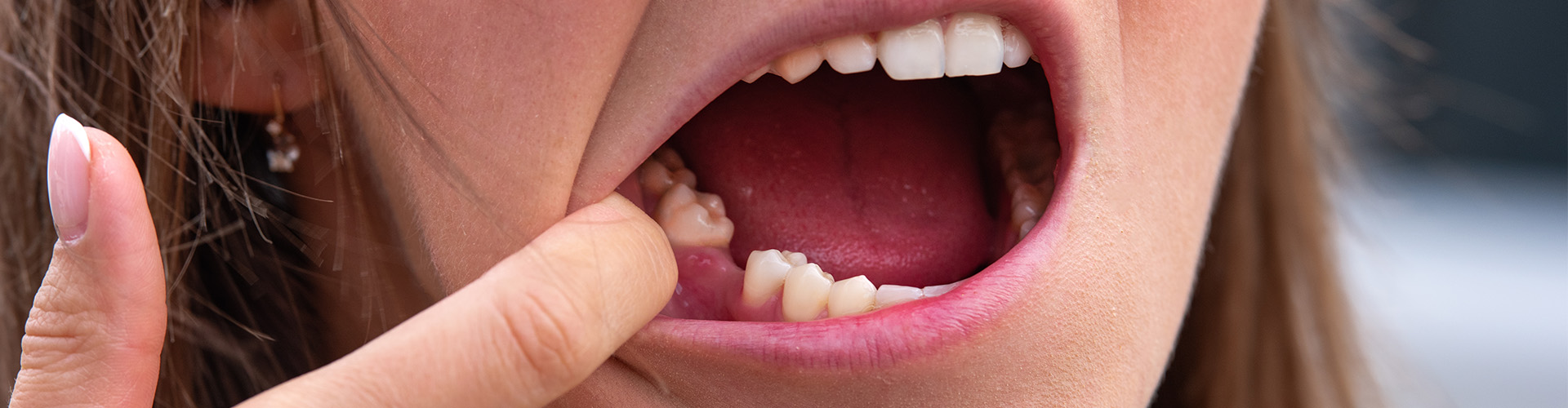 What to Expect After a Tooth Extraction: A Comprehensive Guide