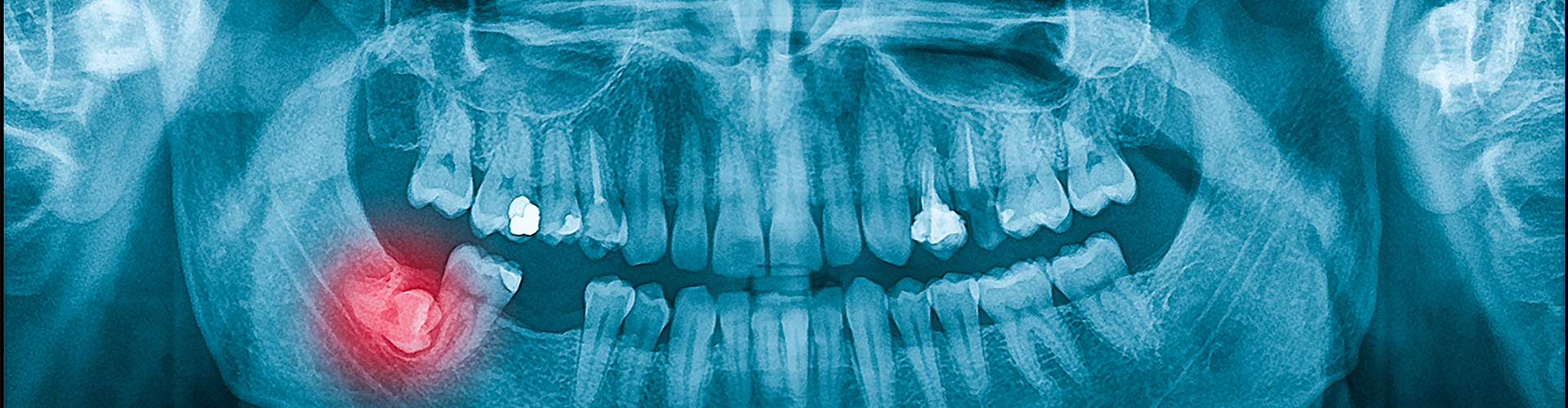 Understanding Impacted Wisdom Teeth