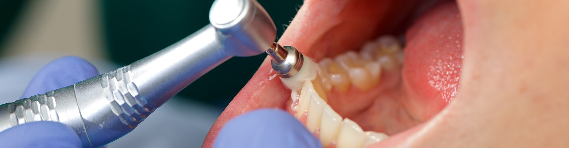 Navigating the Dental Maze: Prophylaxis vs. Deep Cleaning in Oral Health