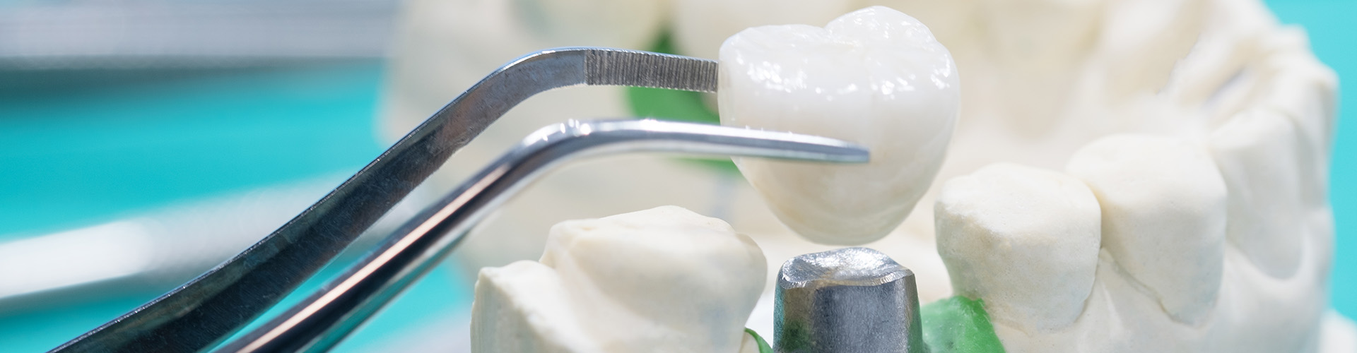 Understanding Dental Crowns: Common Questions Answered