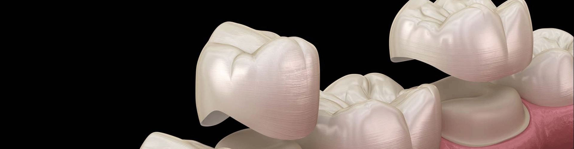 Cracking the Crown Conundrum: All You Need to Know About Dental Crowns