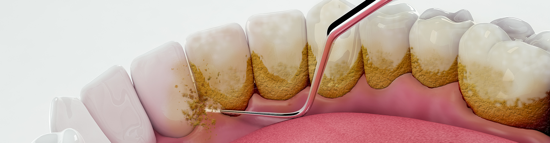 Understanding Full Mouth Debridement
