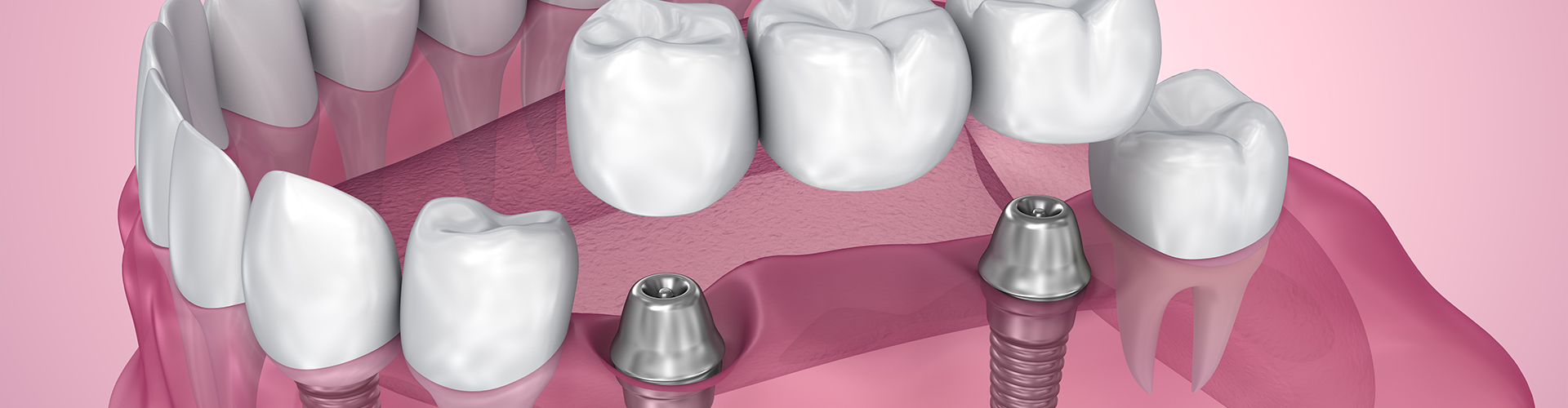 Missing a Tooth? Here’s What to Know About Implants vs. Bridges