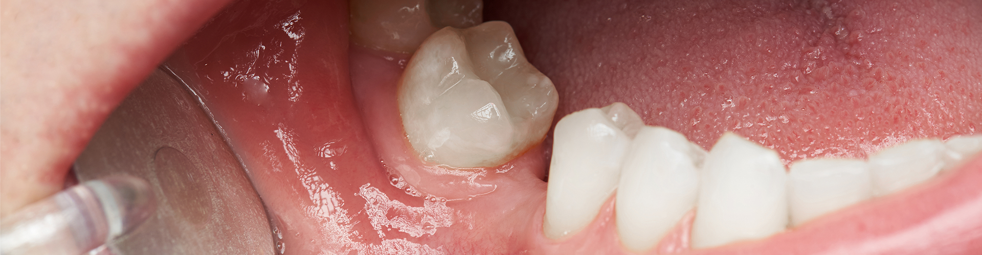 Exploring Tooth Replacement Options: Find Your Ideal Solution
