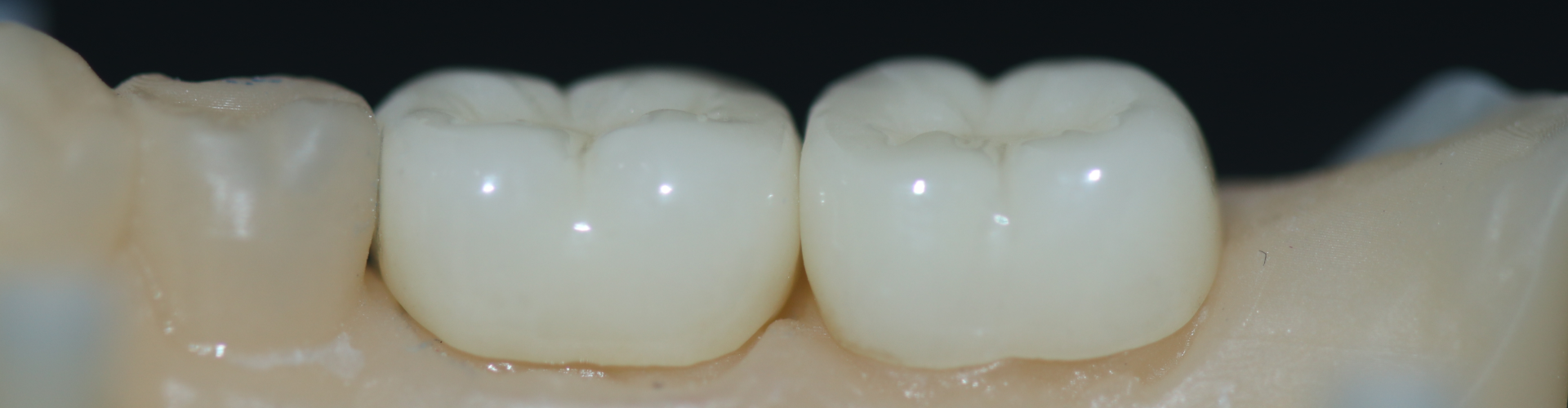 Porcelain Crowns That Feel Like Your Real Teeth, Only Better